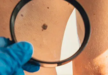 Skin Tags